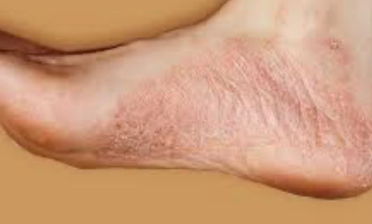 Psoriasis and skin care