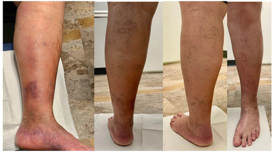 Varicose veins or spider veins