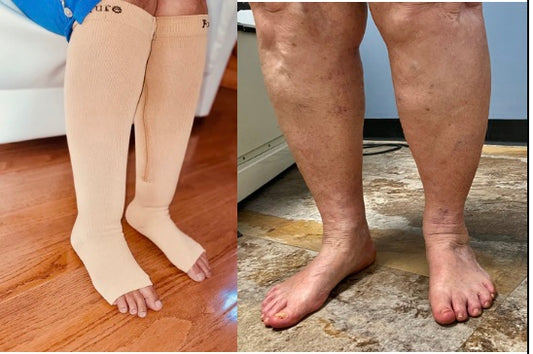 Venous Insufficiency (chronic swelling in legs)