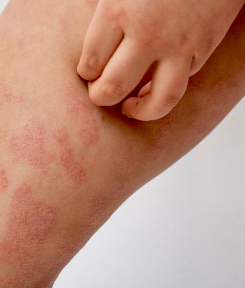 Is you eczema flaring up?